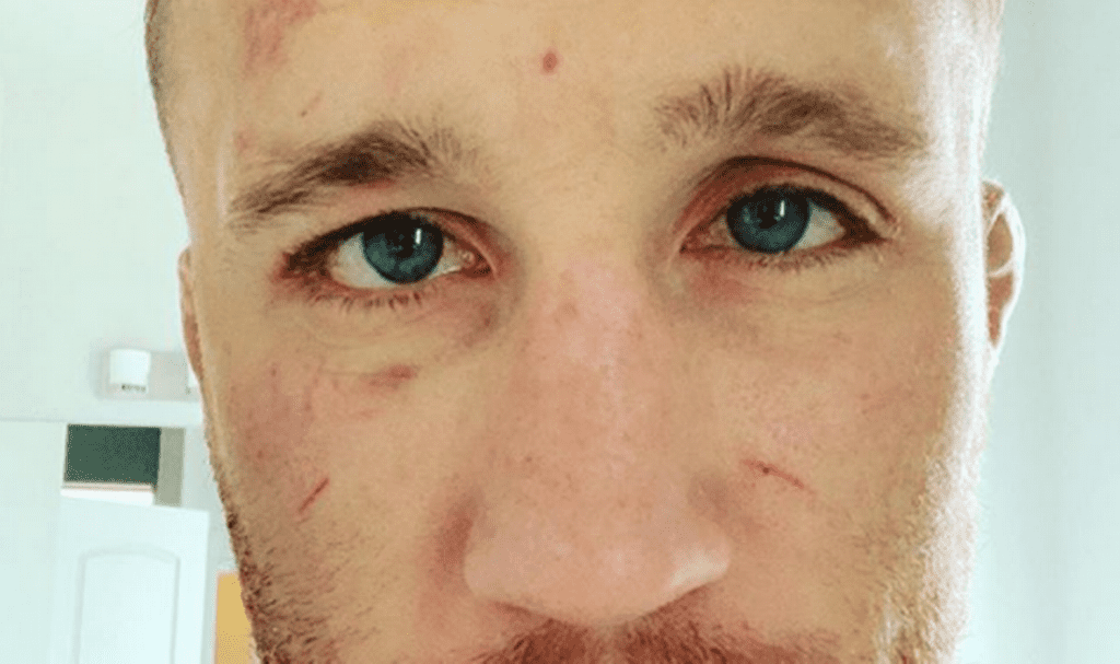 (PHOTO) Gaethje Earns Nasty Cut, Look at His Injury From Wrestling Preparations for Khabib