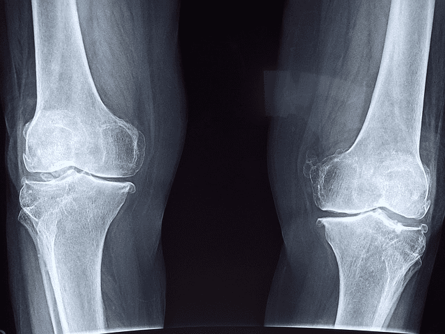 A knees X-ray image
